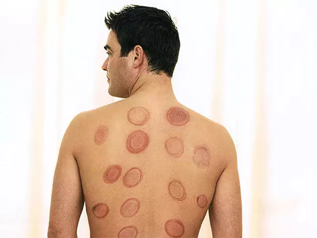 Cupping Therapy Benefits